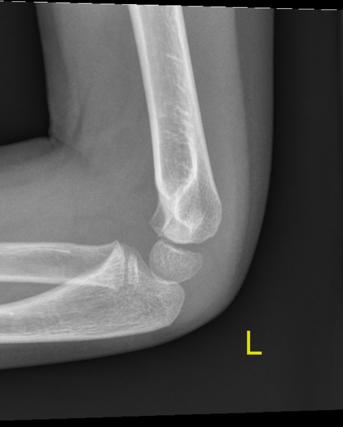 Lateral condyle paeds undisplaced 2